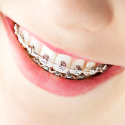 Orthodontics - Special Offer